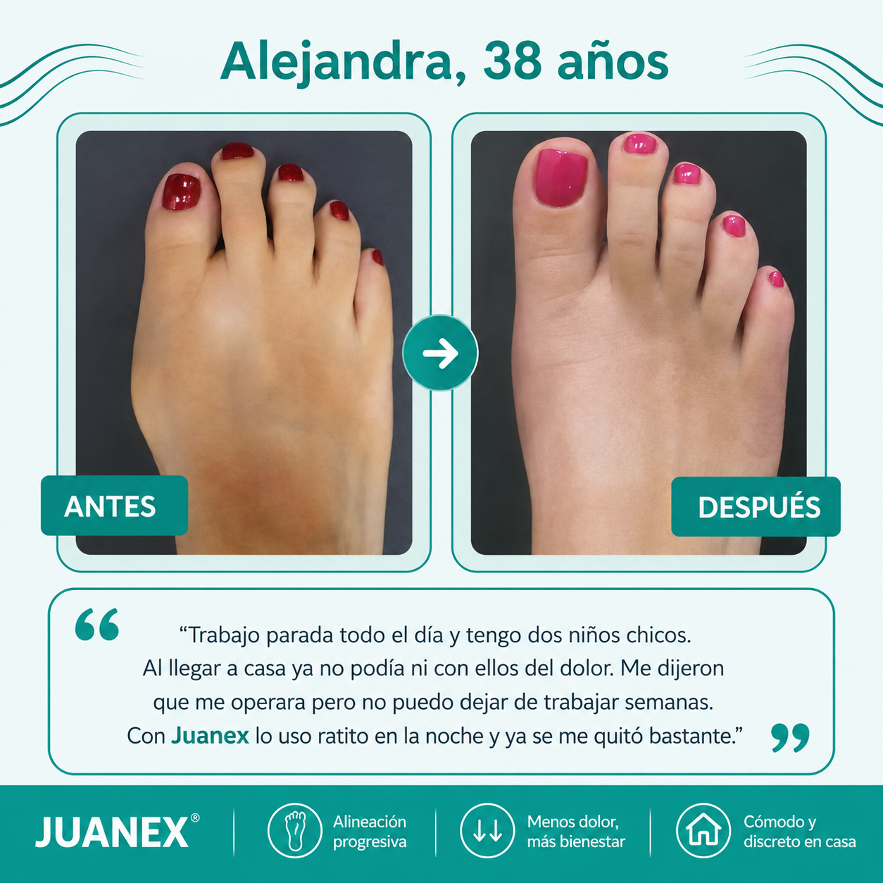 Juanex® | Corrector de Juanetes | ¡PRECIO ESPECIAL 50% OFF!